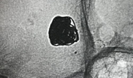 造影视频全过程,揭示血管奥秘与诊疗过程